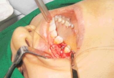 بدء عملية الخياط بإقفال اللثة في فم المريضة