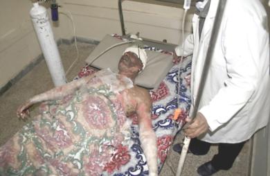 عراقي مصاب يعالج في احدى المستشفيات