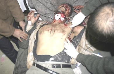 طبيب عراقي يعالج احد المصابين بعد أن قام احد الانتحاريين بتفجير نفسه
