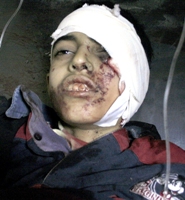 فتى عراقي مصاب