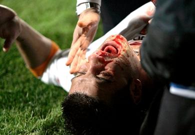 تشيفو لاعب روما اصيب اصابة خطيرة