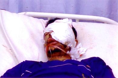 الجريح حسين يحيى بعد إجراء العملية له في مستشفى الجمهورية