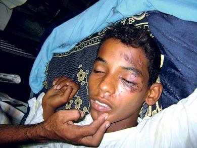 الطفل فاروق عبدالحكيم وتبدو على وجهه آثار الإصابة