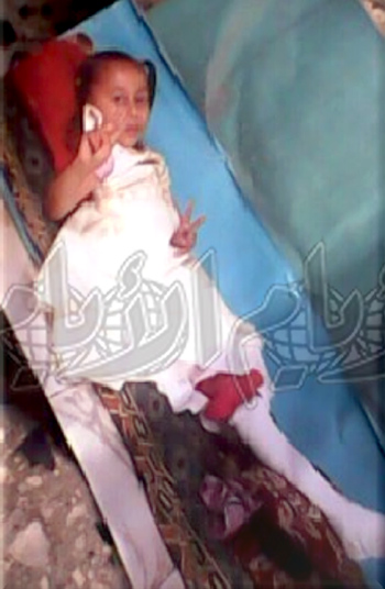 طفلة جريحة جراء استهدف وقصف الجيش على المنازل السكنية بالضالع
