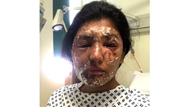 رشام خان تعرضت لتشوهات في وجهها وضرر في عينها اليسرى
