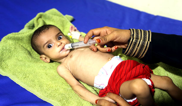 طفل يعاني من سوء التغذية يتلقى العلاج في مستشفى بمدينة الحديدة 