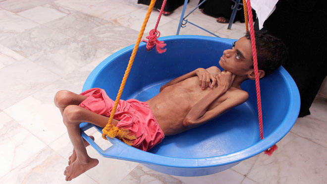 طفل يعاني من سوء تغذية