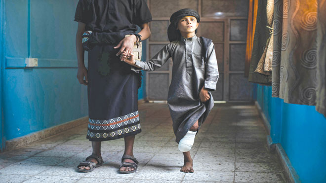 طفل يمني تعرضت قدمه للبتر بعد انفجار لغم