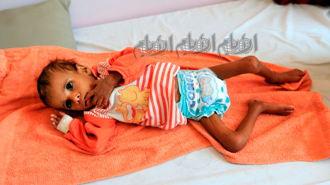 وضع طفل يمني يعاني من سوء التغذية على سرير في مركز للعلاج في مستشفى بصنعاء