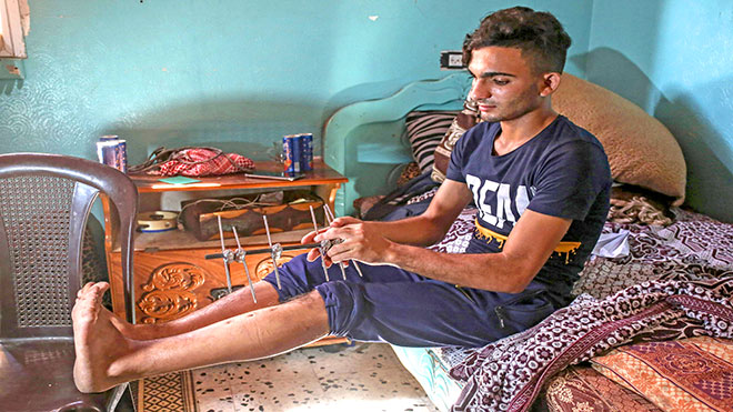 المحتج الفلسطيني محمد حليس يحمل مثبتًا خارجيًا في غرفته في ضاحية الشجاعية بشرق مدينة غزة