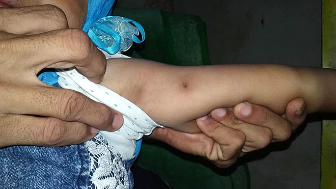 انتشار مرض جلد بردفان يصيب الأطفال