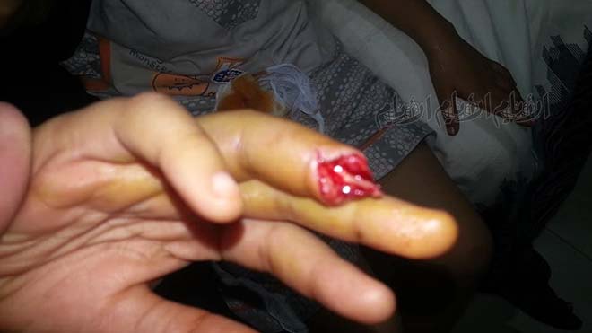 الجرح على إصبع الطفلة سجى قبل خضوعها للعملية