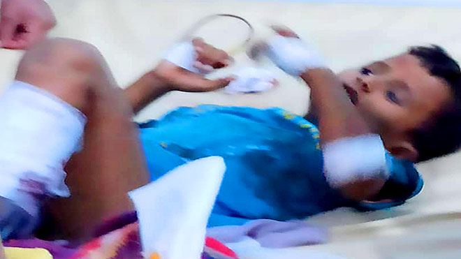 طفل جريح يتلقى العلاج  من قصف قوات الشرعية لمديرية نصاب بشبوة