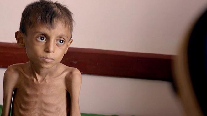 يوصف الوضع في اليمن بأنه أسوأ كارثة إنسانية يشهدها العالم