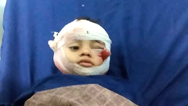 طفل جريح من الحادثة في الخد الأيمن