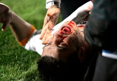 تشيفو لاعب روما اصيب اصابة خطيرة تشيفو لاعب روما اصيب اصابة خطيرة
