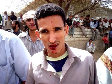 أحد الجرحى والدماء على وجهه أحد الجرحى والدماء على وجهه