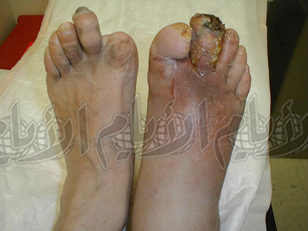 سكري القدم