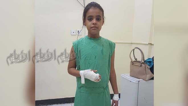 الطفلة سجى بعد خضوعها لعملية فصل الإصبع عن البطن الطفلة سجى بعد خضوعها لعملية فصل الإصبع عن البطن