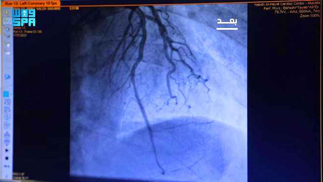 بعد العملية بعد العملية